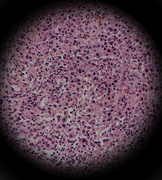 Melanoma cells in microscope